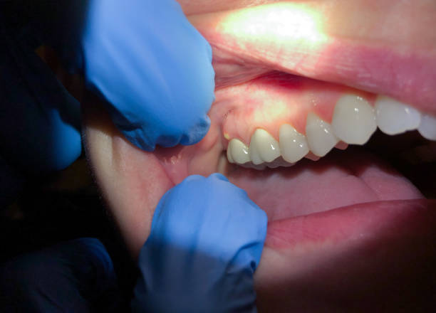 Best Dentist for Tooth Abscess  in Fort Totten, ND